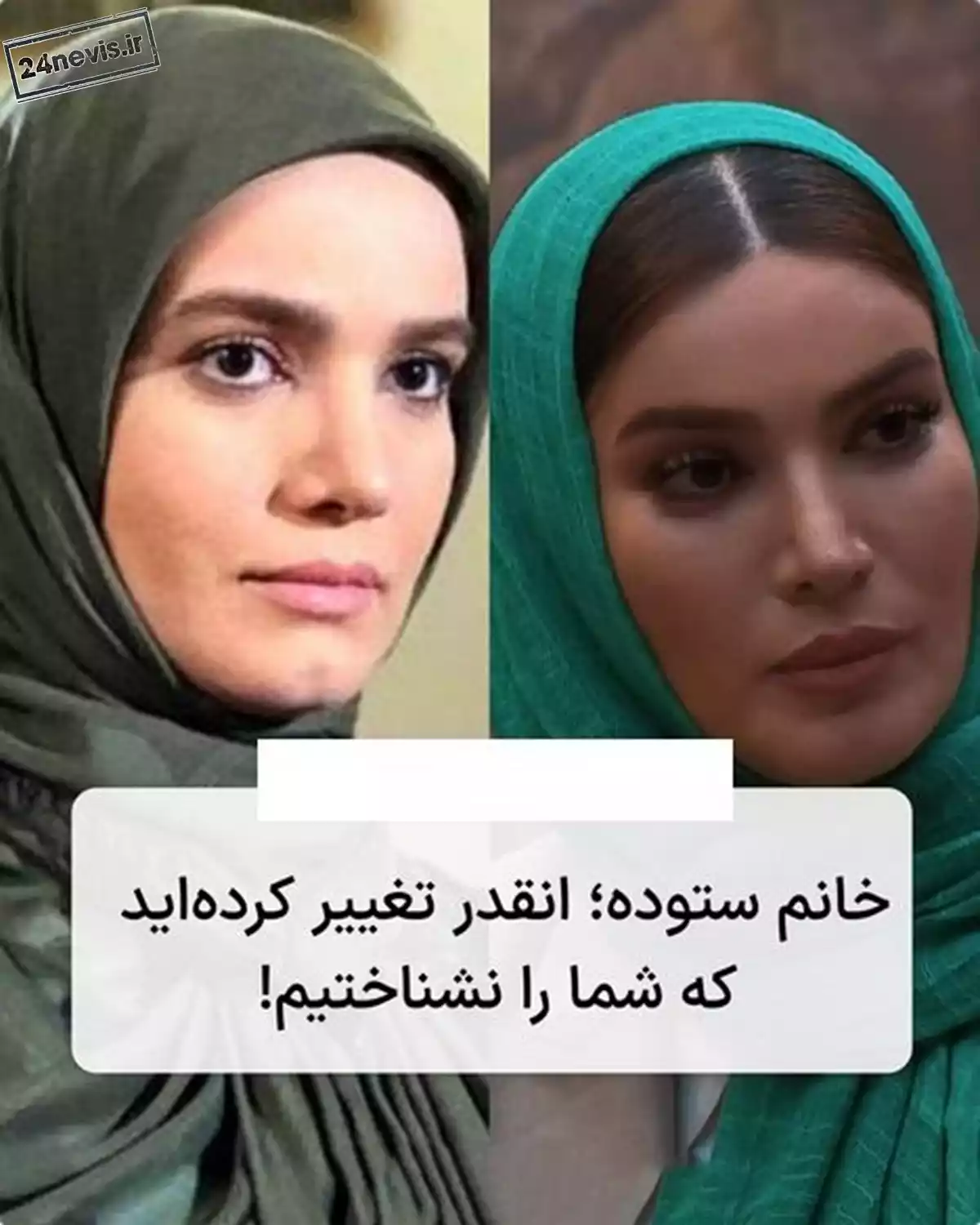عکس متین ستوده قبل از عمل زیبایی